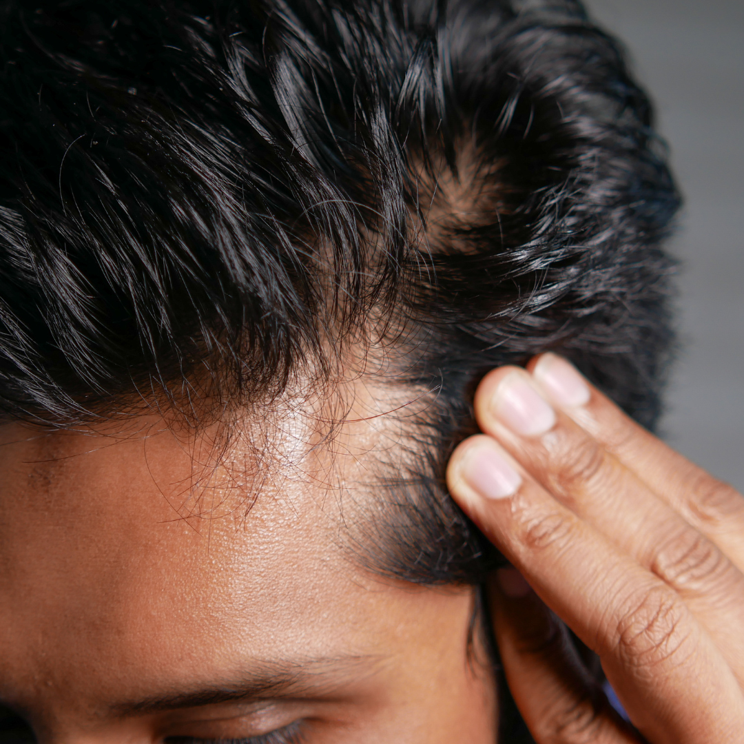 How Stress Impacts Hair Loss